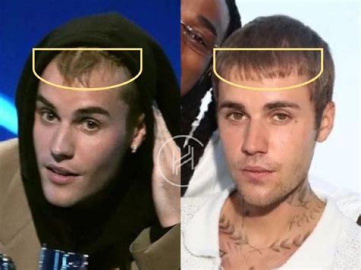 Justin Bieber's Hair Loss: The Causes, Treatment, And Impact