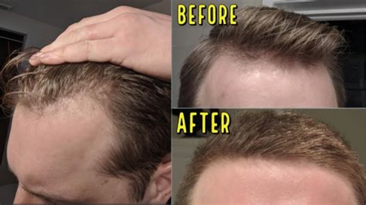 Justin Bieber's Shocking Hair Loss: Causes And Treatments