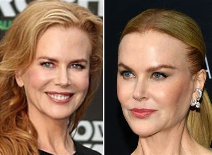 The Complete Transformation Of Nicole Kidman: Before And After Surgery