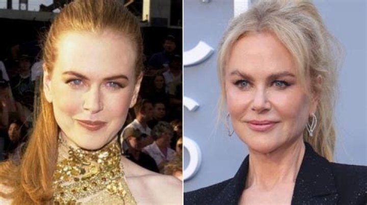 Unveiling Nicole Kidman's Facelift: A Transformative Journey